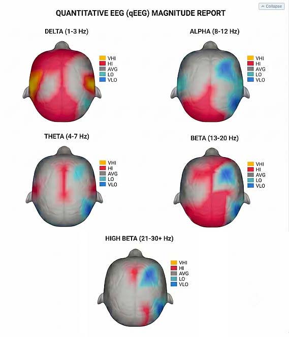QEEG Brain Showing Results of a Brain Scan on a Neurofeedback Therapy Patient